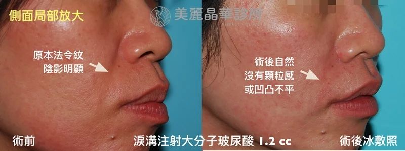 玻尿酸改善法令與木偶紋術前術後右側照
