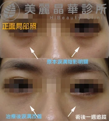 玻尿酸填補淚溝術前術後比對