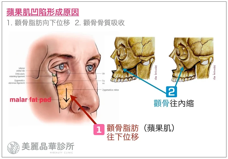 玻尿酸填補治療解釋蘋果肌凹陷原因