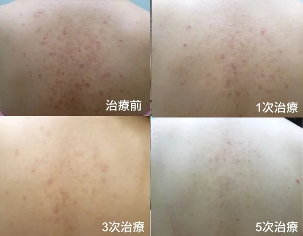 德國光纖粉餅雷射五次背部治療改善紅痘疤與暗沉色素不均