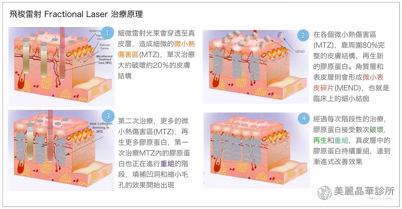 飛梭雷射治療原理