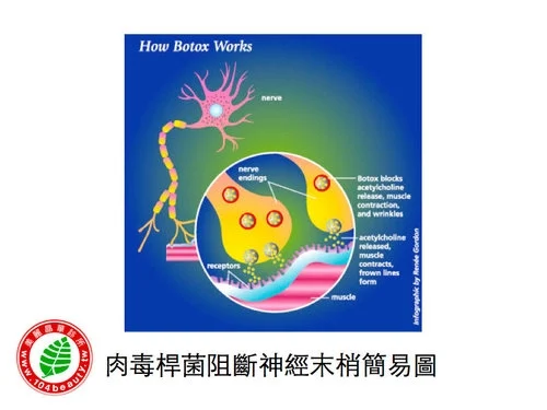 肉毒桿菌阻斷神經末梢簡易圖