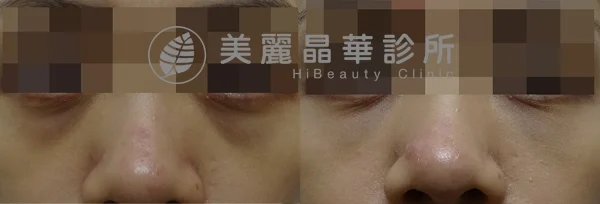 德國光纖粉餅雷射治療色素+血管型黑眼圈