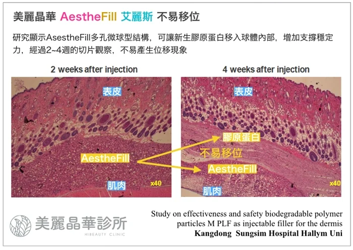 艾麗斯Aesthefill新生膠原蛋白不易移位