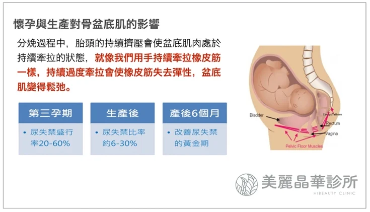 EMSELLA幸福G動椅-懷孕與生產對骨盆底肌的影響