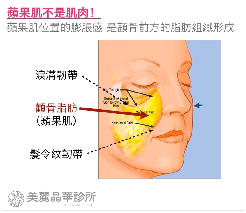 玻尿酸填補蘋果肌治療位置解釋