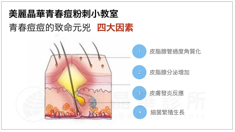 青春痘形成四大因素