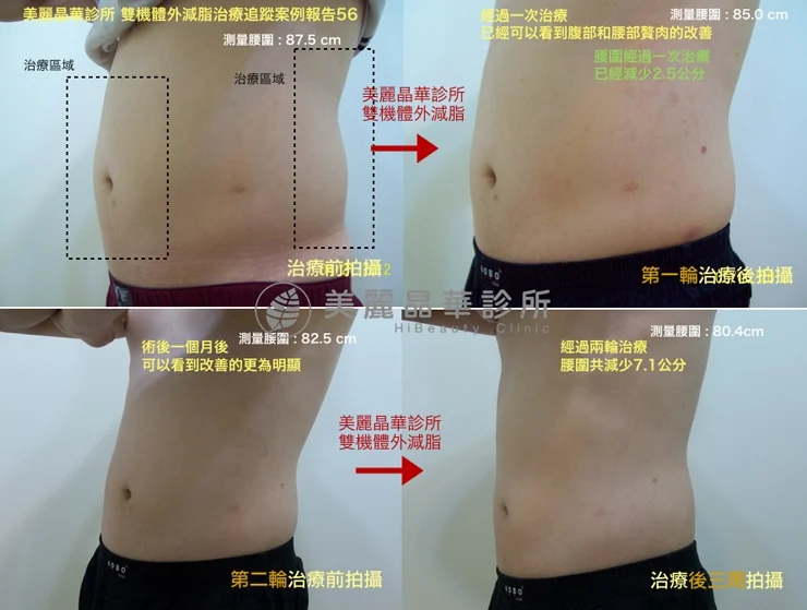 酷塑冷凍溶脂追蹤案例報告56