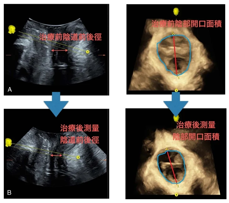EMSELLA幸福G動椅治療私密處核心肌肉群