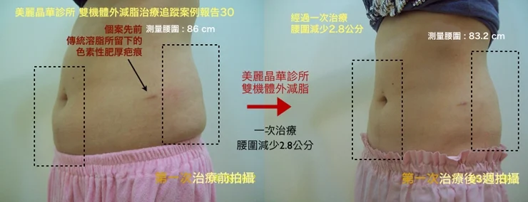 酷塑冷凍溶脂追蹤案例報告30