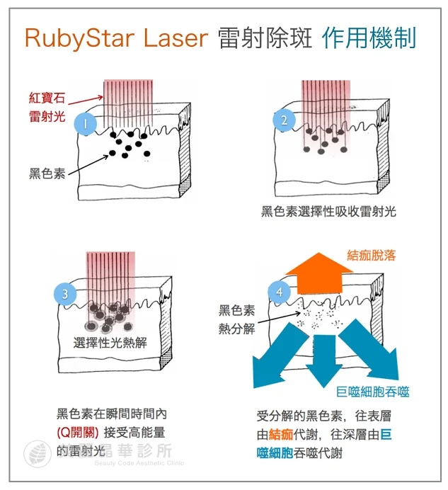 紅寶石雷射除斑作用機制