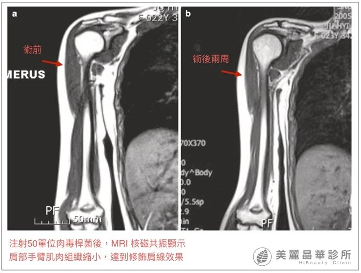 瘦肩治療MPI顯示術前術後差異