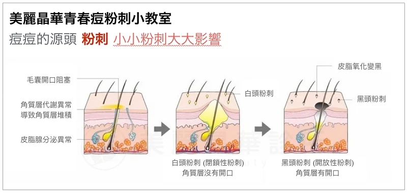 粉刺是青春痘形成的開始