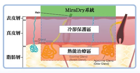 miraDry腋淨爽磁性性能反射
