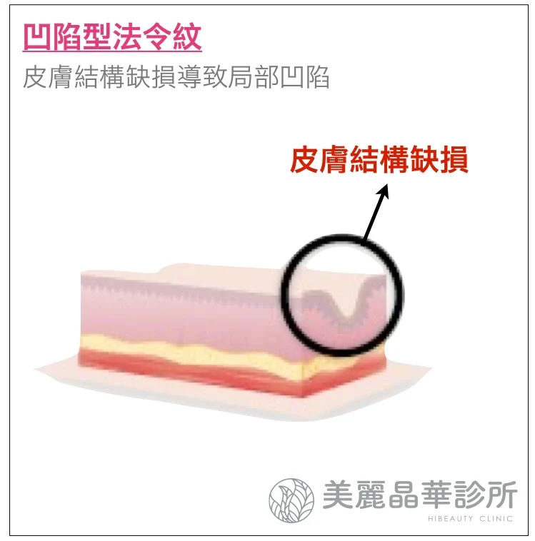 玻尿酸填補凹陷型法令紋