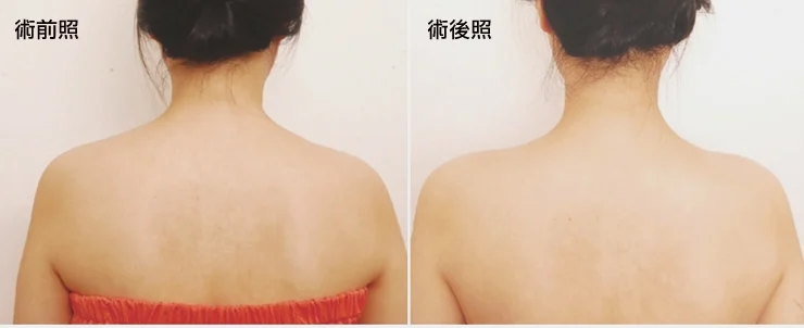 瘦肩治療術前術後比對案例1