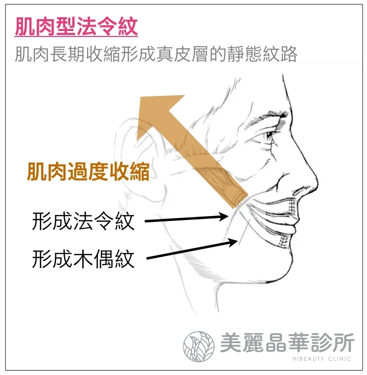 玻尿酸填補肌肉型法令紋