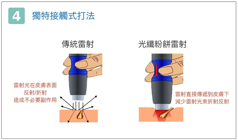 德國光纖粉餅雷射優勢-獨特接觸式打法