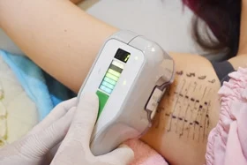 miraDry腋淨爽儀器接上原廠探頭