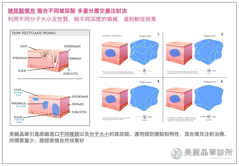 玻尿酸填充多重分層交疊注射法